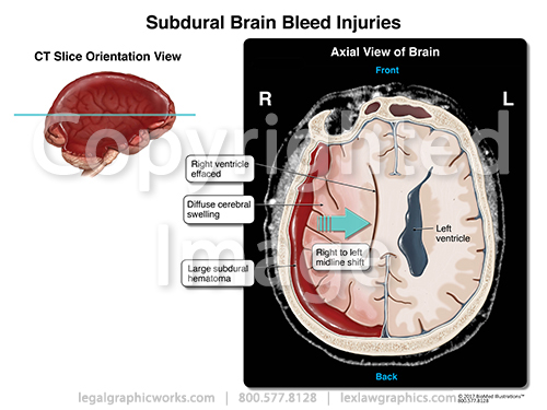 progressive subdural bleed legal