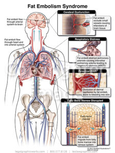 Fat Embolism Syndrome - Legal Graphicworks