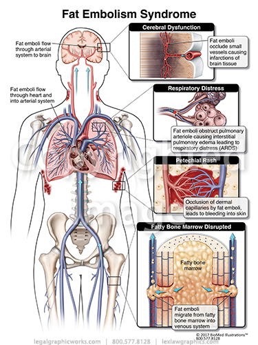 Fat Embolism Syndrome Legal Graphicworks