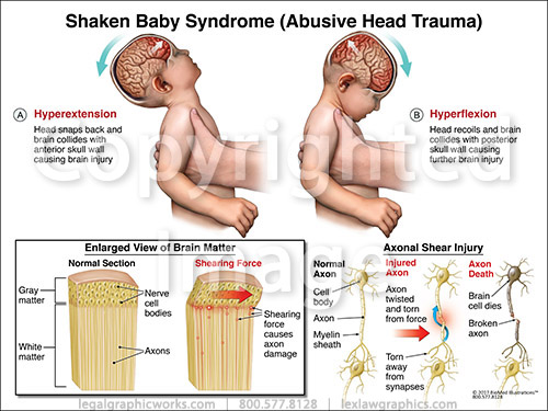 Синдром встряхнутого ребенка до какого возраста. Синдром встряхнутого младенца. Синдром тряски младенца. Синдром встряхнутого ребенка. Синдром встряхнутого ребенка.