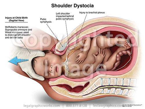 shoulder dystocia legal graphicworks shoulder dystocia