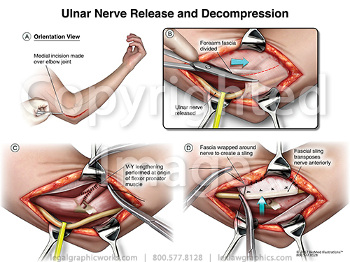 Ulnar Nerve Decompression - Legal Graphicworks