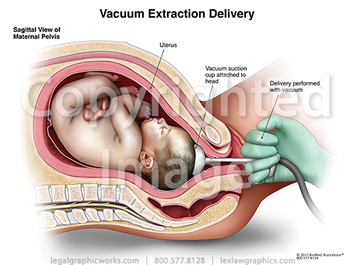 vacuum extraction delivery legal graphicworks vacuum delivery