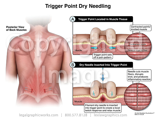 Trigger Point Injections Legal Graphicworks