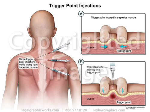 Trigger point injections legal graphicworks